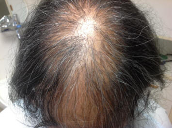 alopecia lupus